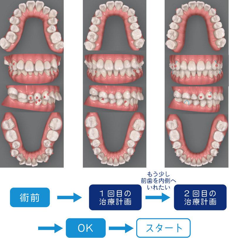 クリンチェックの様子