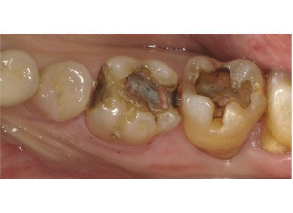 古い詰め物・虫歯の除去