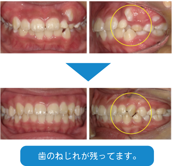 I期治療で70点の歯並びになりました