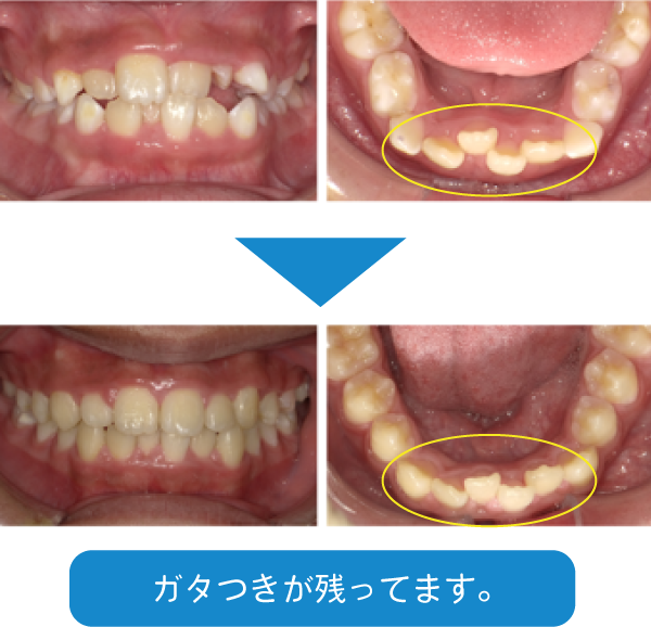 I期治療で70点の歯並びになりました