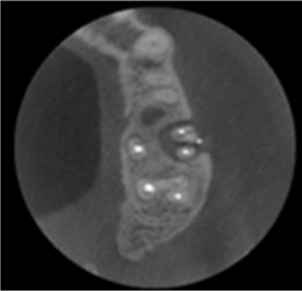 歯科用CT画像3