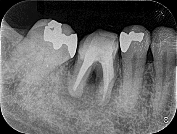 破折ファイルを取り除き、お薬を詰め直します