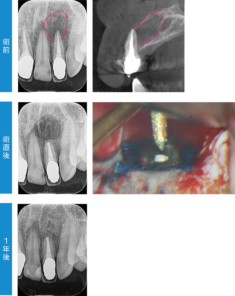 術前、術直後、1年後の様子