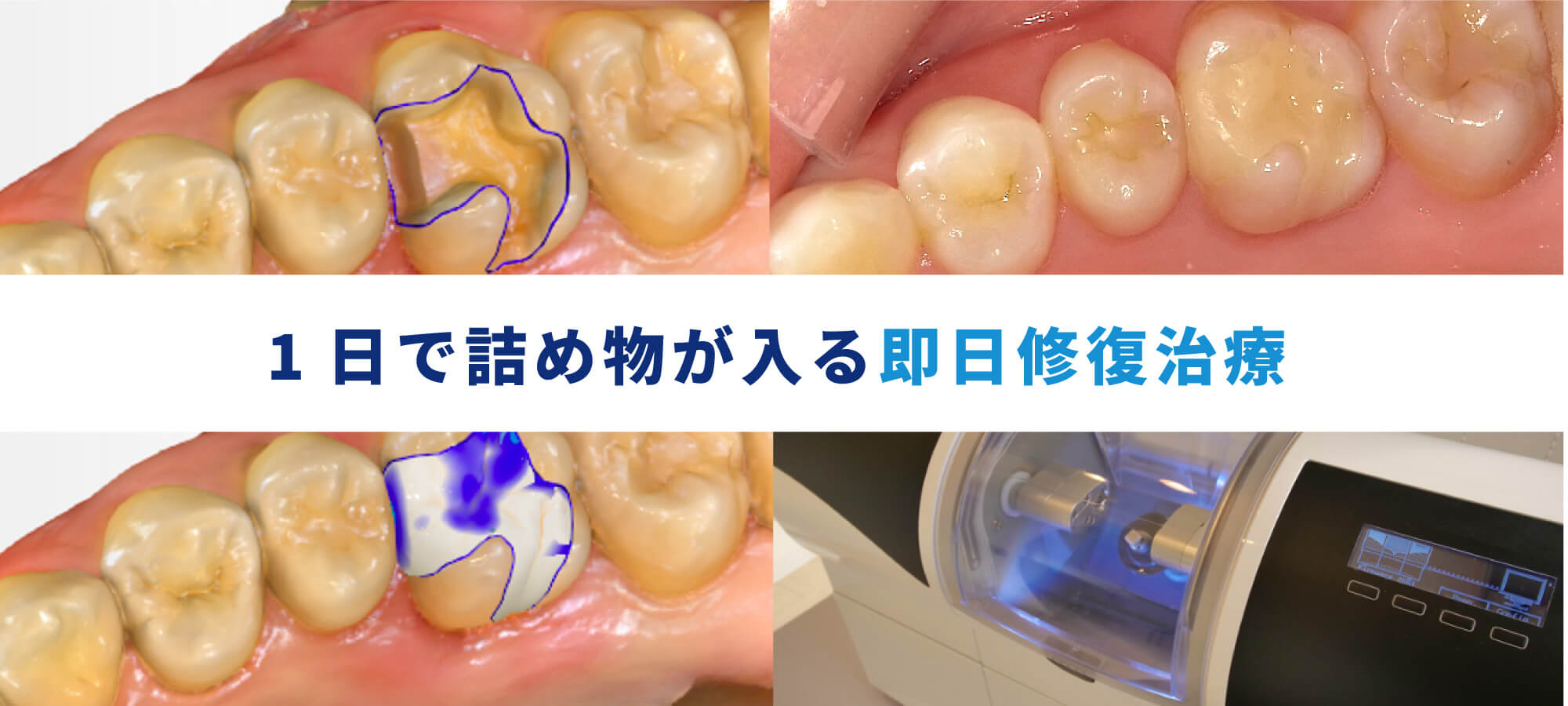 1日で詰め物が入る即日修復治療