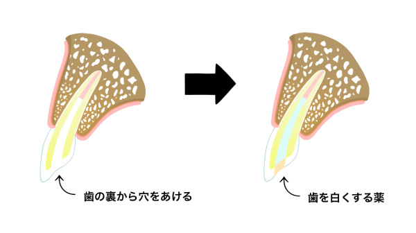 ウォーキングブリーチのについて